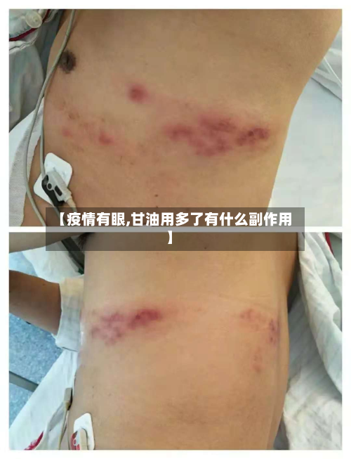 【疫情有眼,甘油用多了有什么副作用】-第2张图片